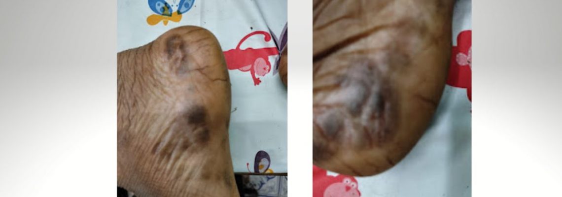 आयु ५०/ f, this type of lesion since १ month, कृपया  मार्ग दर्शन guruji, no any symptoms.